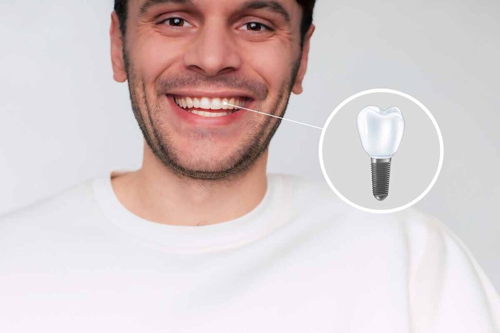 full-mounth-implant-in-turkey