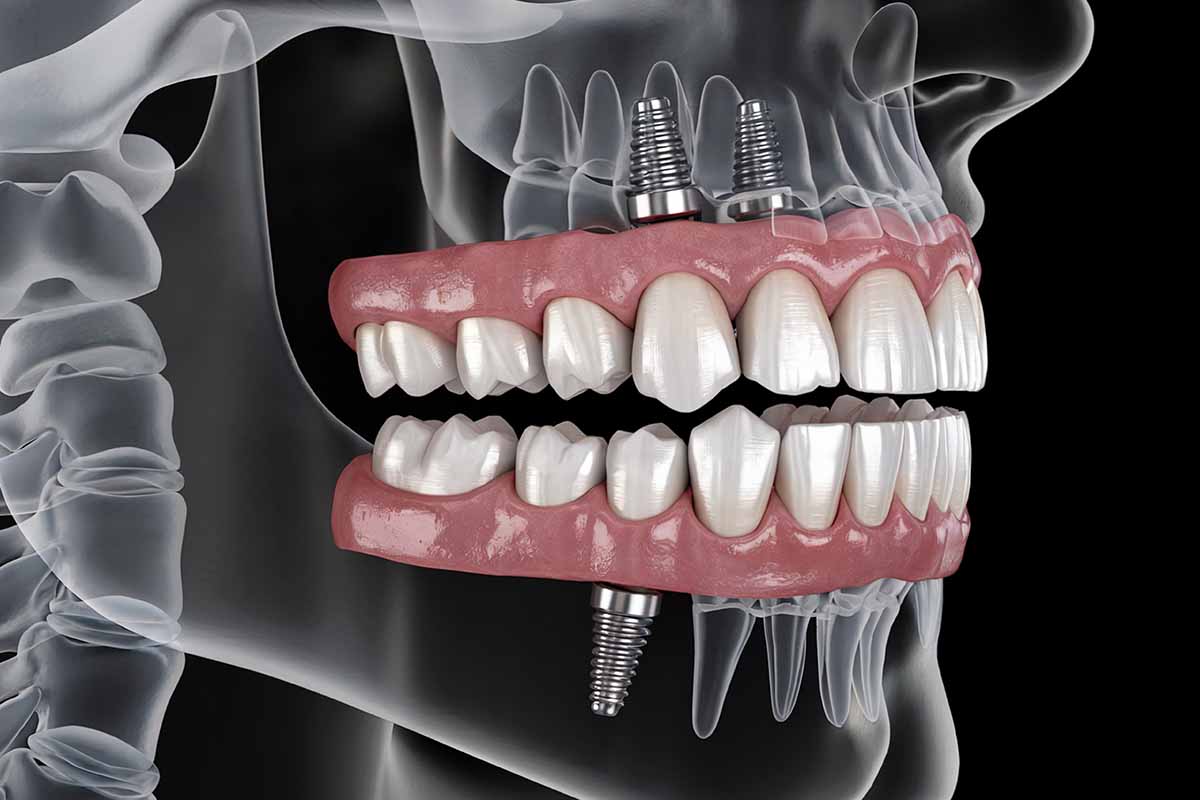 implant-in-turkey
